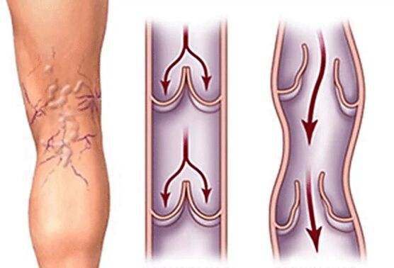 Normal veins and varicose veins