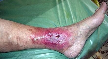 Complications of varicose veins
