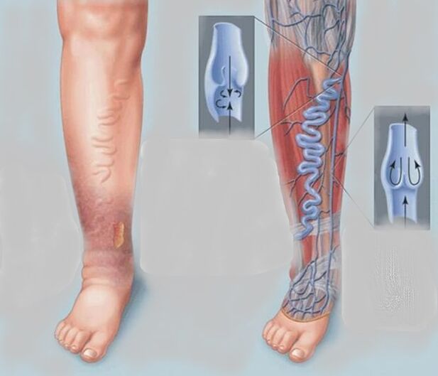 Varicose veins in legs
