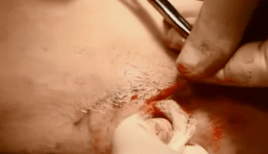 Types of surgery to remove varicose veins