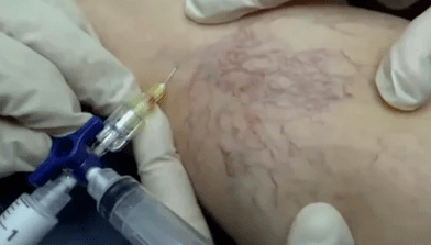 Varicose vein sclerotherapy
