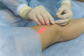 Surgical intervention for varicose veins in the legs
