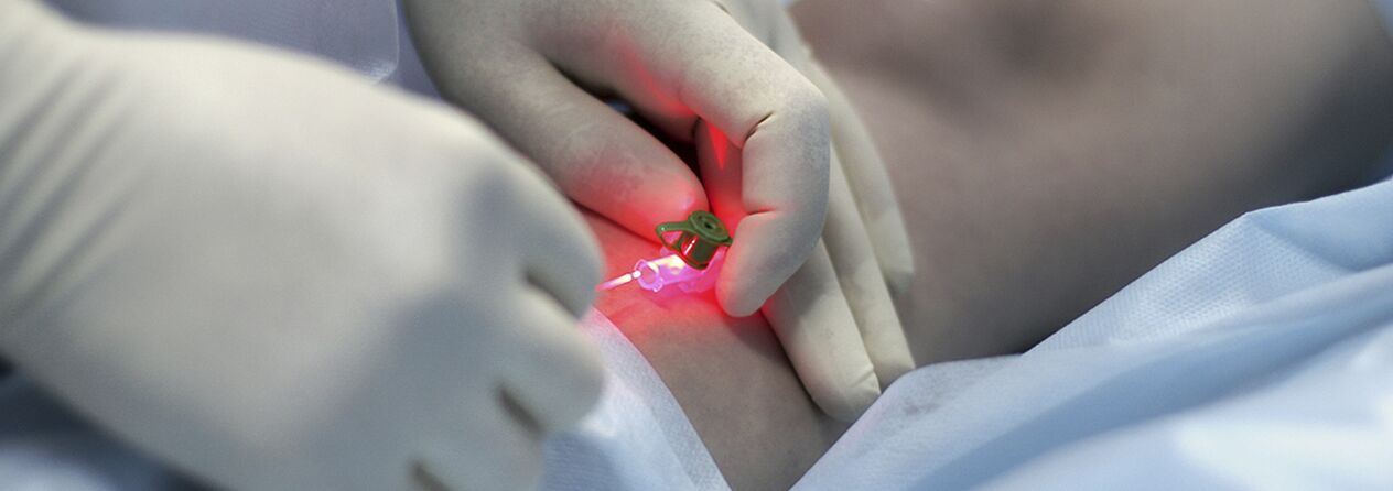 Compression sclerotherapy