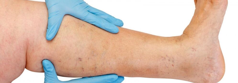 Varicose veins in legs