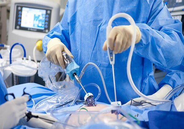 Surgical treatment of pelvic varicose veins