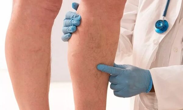 Doctor checks legs for varicose veins